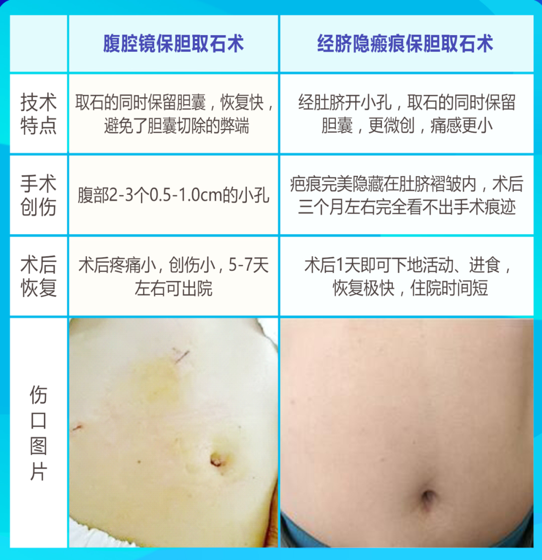 传统保胆取石术vs经脐隐瘢痕保胆取石术.jpg