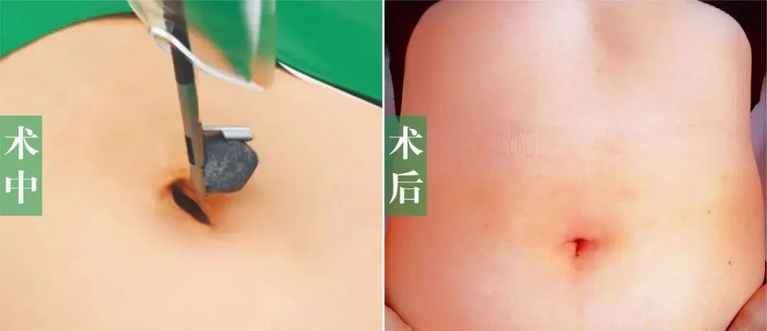 经脐隐瘢痕保胆取石术