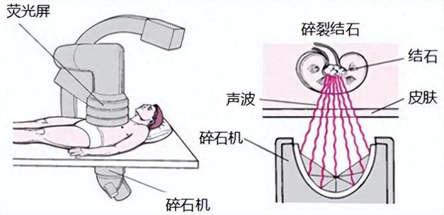 体外冲击波碎石术