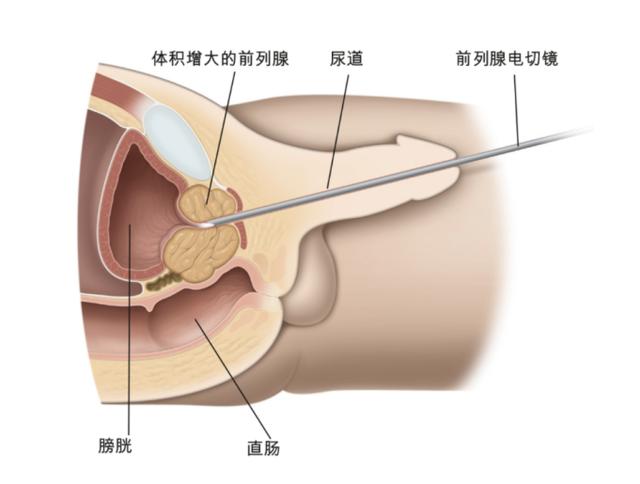 等离子前列腺气化电切术